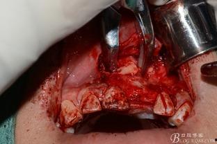 成人埋伏牙拔除视频,成人埋伏牙拔除手术过程解析